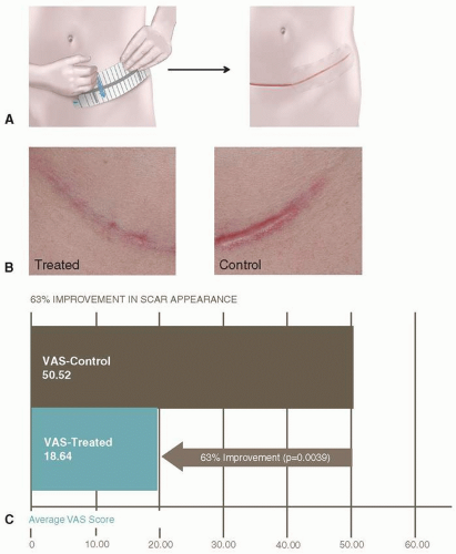 An Approach To Scar Mitigation | Plastic Surgery Key