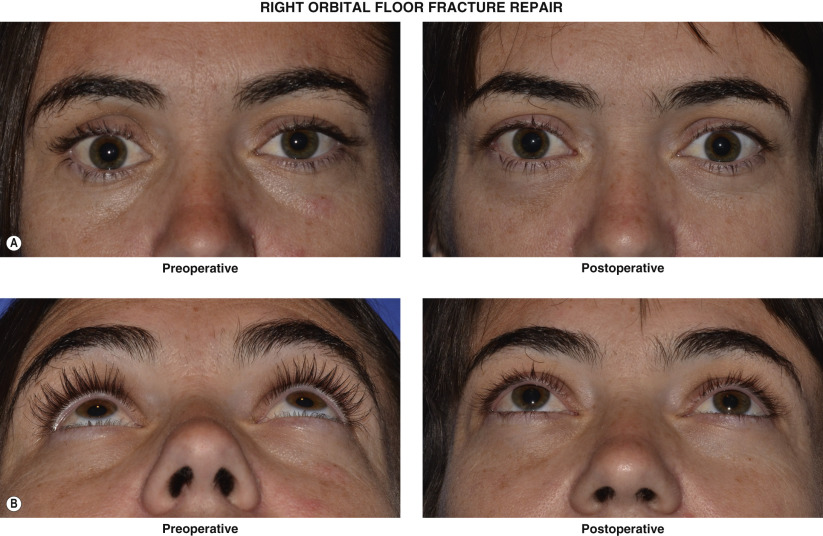 Orbital Floor Fracture Complications - Reba Higginbotham