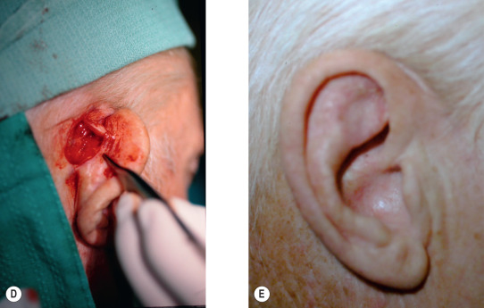 Local flaps for facial coverage - Plastic Surgery KeyPlastic