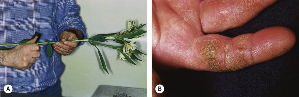Dermatoses Due to Plants - Plastic Surgery KeyPlastic Surgery Key