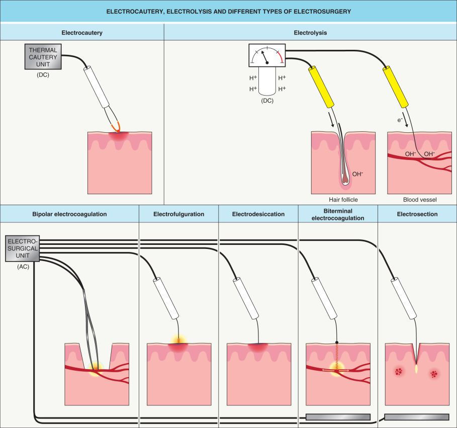 Electrosurgery | Plastic Surgery Key