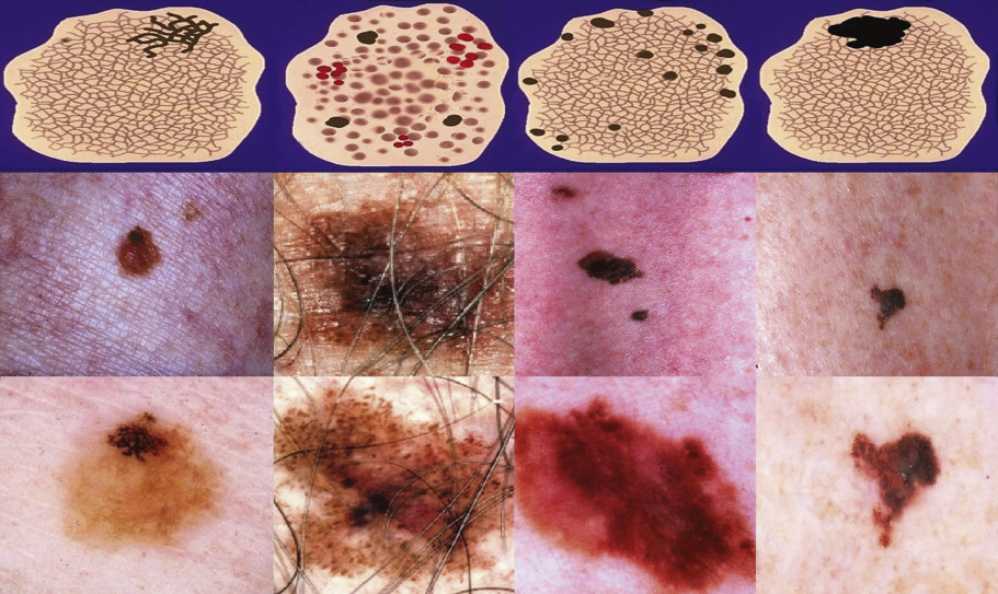 Benign Melanocytic Neoplasms