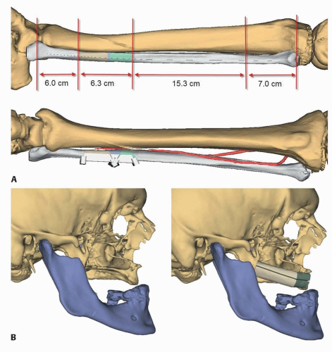 Free Fibula Flap For Midface Reconstruction | Plastic Surgery Key