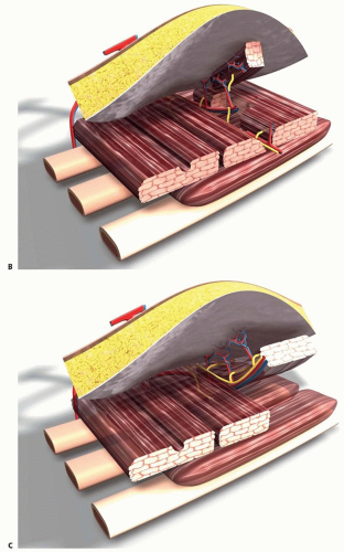 Local Flaps In Partial Breast Reconstruction | Plastic Surgery Key