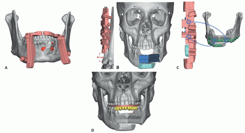 Mandible Reconstruction With Fibula Free Flap Using CAD/CAM Techniques ...