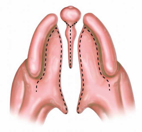 Conjoined Twin Separation | Plastic Surgery Key