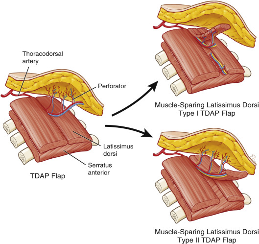 Partial Breast Reconstruction With Flaps | Plastic Surgery Key