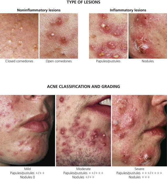 Acne, Rosacea, And Related Disorders | Plastic Surgery Key