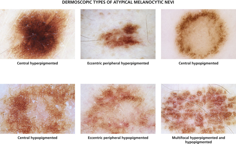 melanotic vs melenic Melena, Causes, Signs and Symptoms, Diagnosis and Treatment main image 1