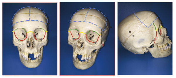 2 Craniofacial Syndromes | Plastic Surgery Key