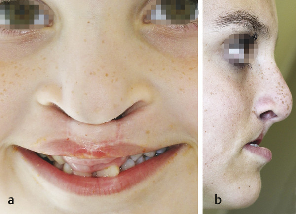 14 Bilateral Cleft Lip | Plastic Surgery Key