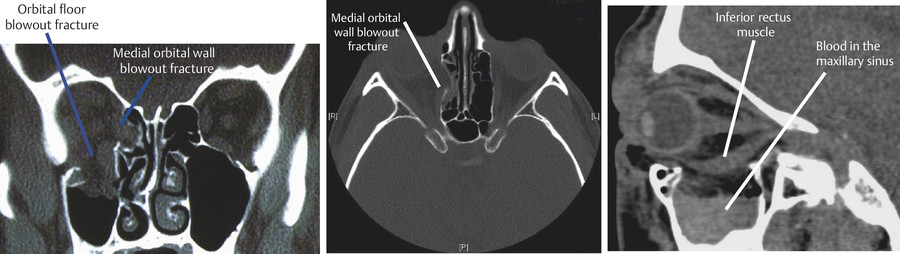 26 Orbital Wall Blowout Fractures | Plastic Surgery Key