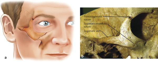 27 Zygomatic Complex Fractures | Plastic Surgery Key