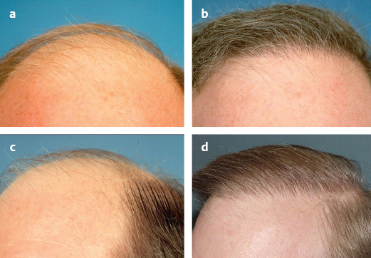 31 Hair Transplantation | Plastic Surgery Key