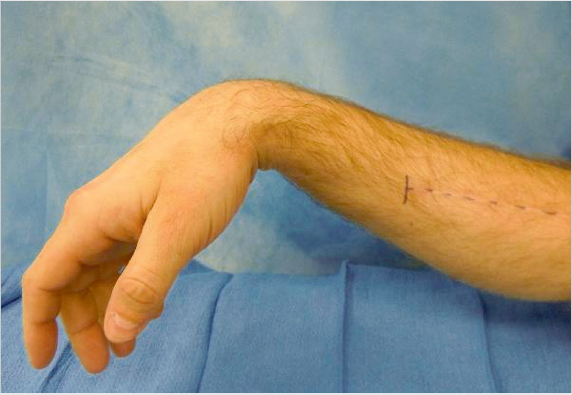 Radial Nerve Injury | Plastic Surgery Key