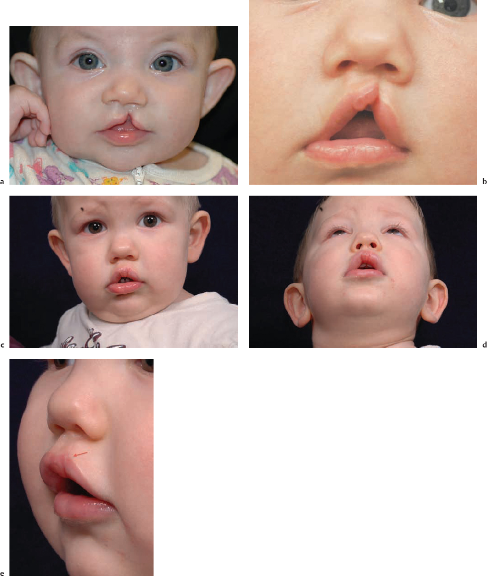 4 Cleft Lip Repair: Unilateral | Plastic Surgery Key