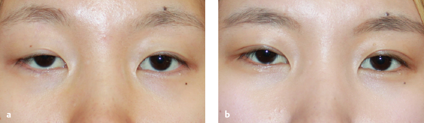 17 Correction Of Ptosis | Plastic Surgery Key