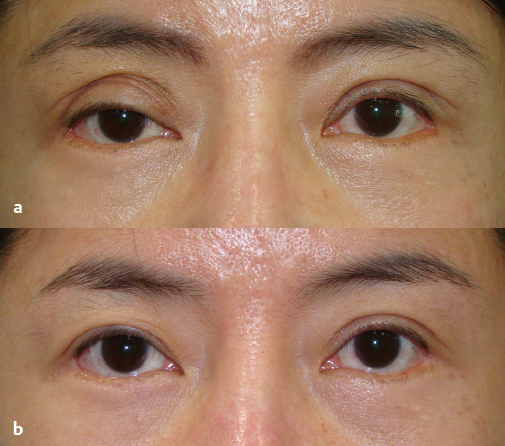 18 Management Of Double-Eyelid Surgery Complications | Plastic Surgery Key