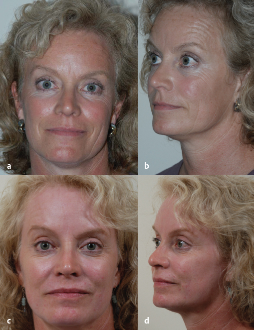 20 Ablative Laser Facial Skin Rejuvenation | Plastic Surgery Key