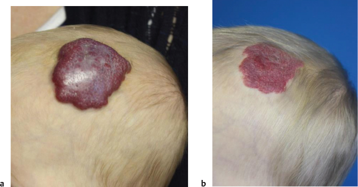 73 Management Of Vascular Anomalies: Hemangiomas And Malformations ...