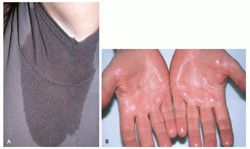 Hyperhidrosis | Plastic Surgery Key