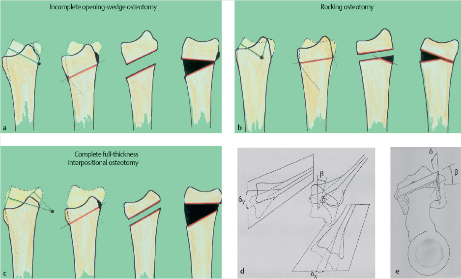 53 Distal Radius Osteotomy For Malunion: Dorsal Approach | Plastic ...