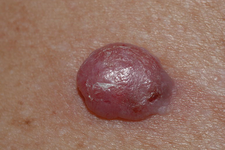 melanotic sarcoma is a skin cancer that begins with quizlet Melanoma Treatment (PDQ)Health Professional Version Melanoma - Plastic Surgery KeyPlastic