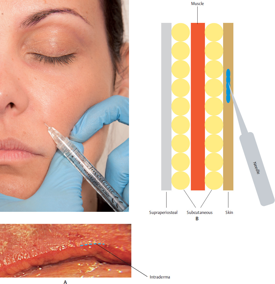 Chapter 12 Filler Injection Of The Nasolabial Fold | Plastic Surgery Key