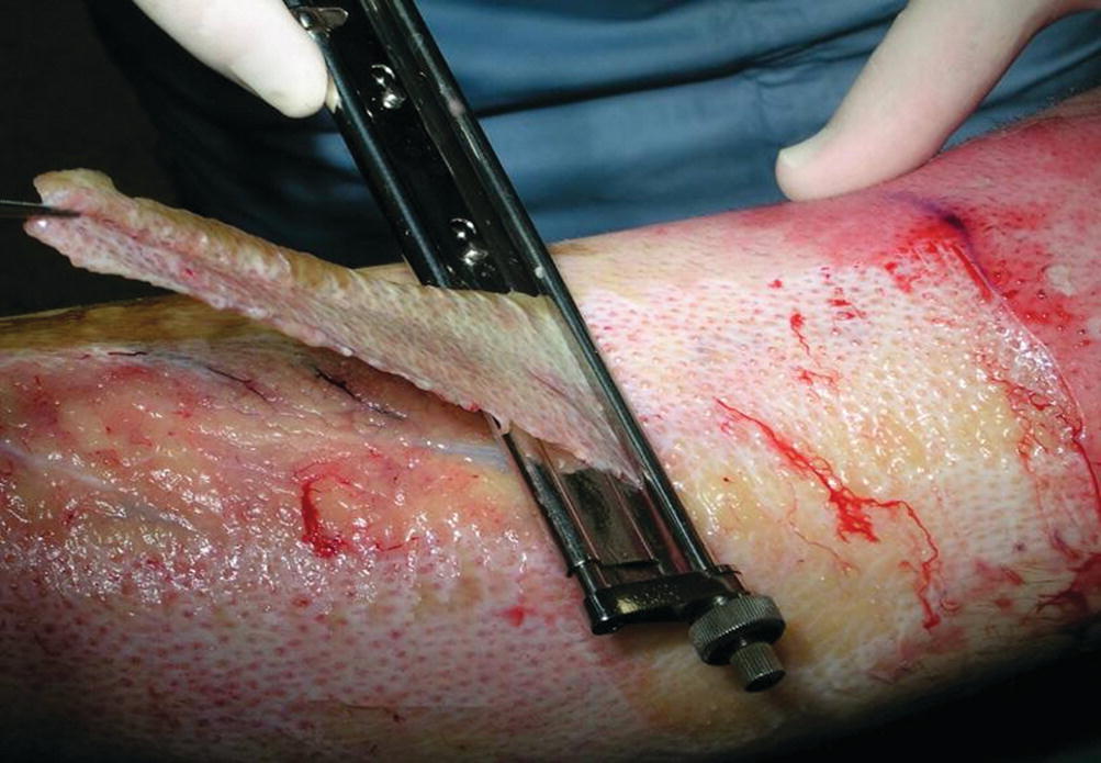 burn debridement