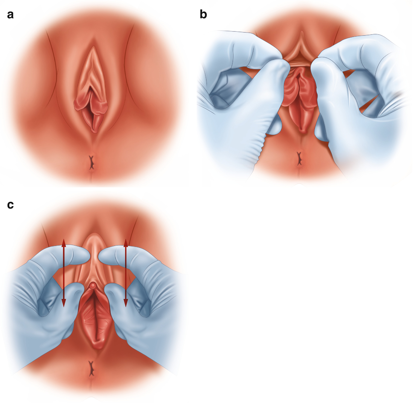 Hoodectomy uk