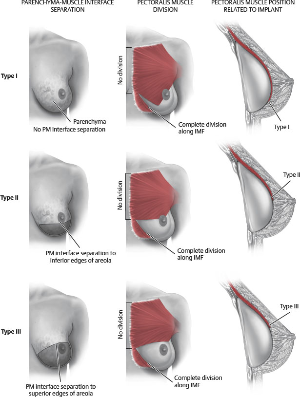 Breast Augmentation  Plastic Surgery Key