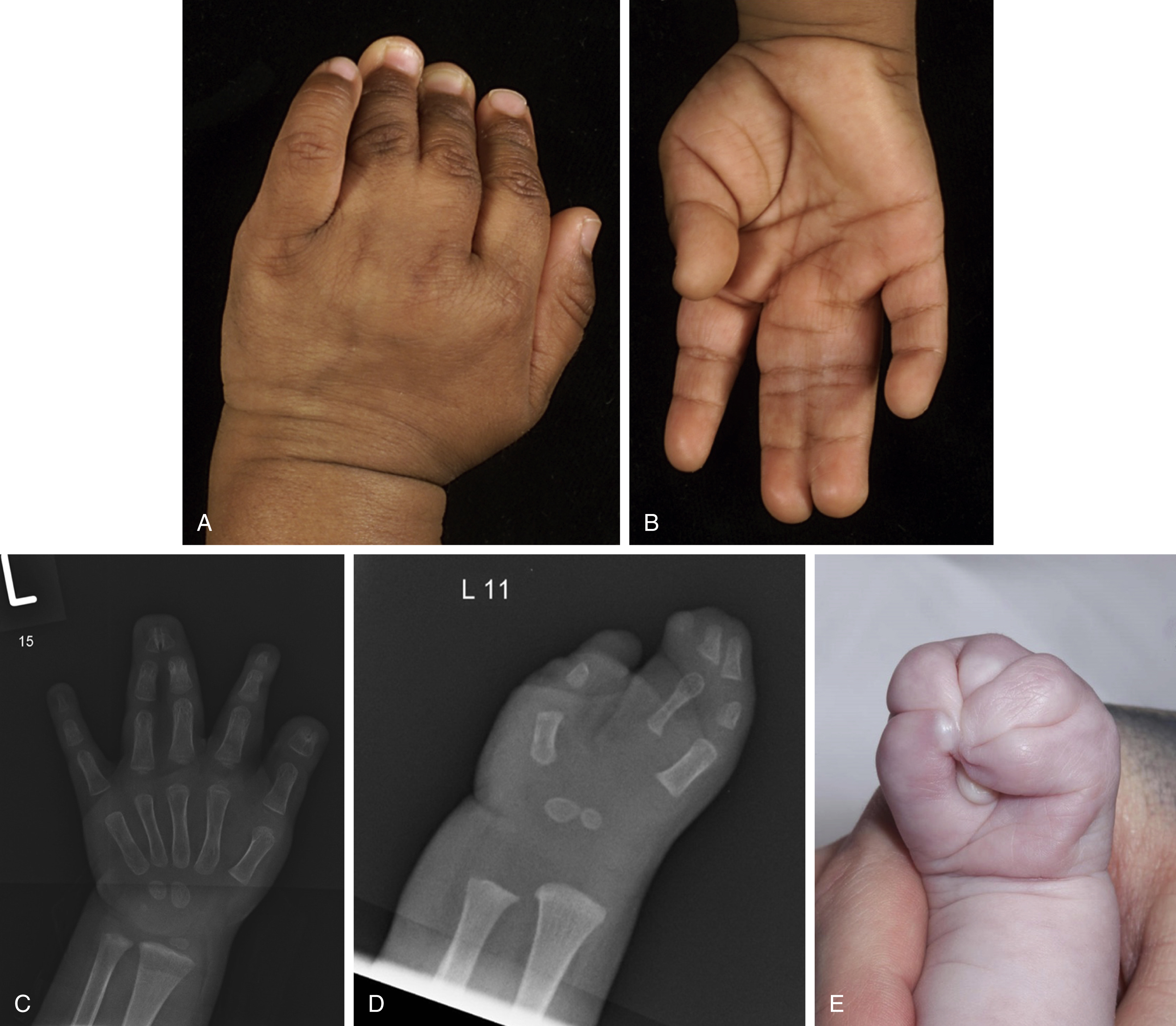 Congenital Hand Differences | Plastic Surgery Key