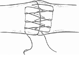 15 Extensor Tendon Injury, Repair, and Reconstruction - Plastic