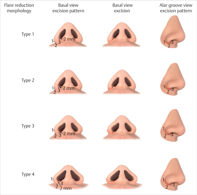 27 Alar Base Surgery | Plastic Surgery Key