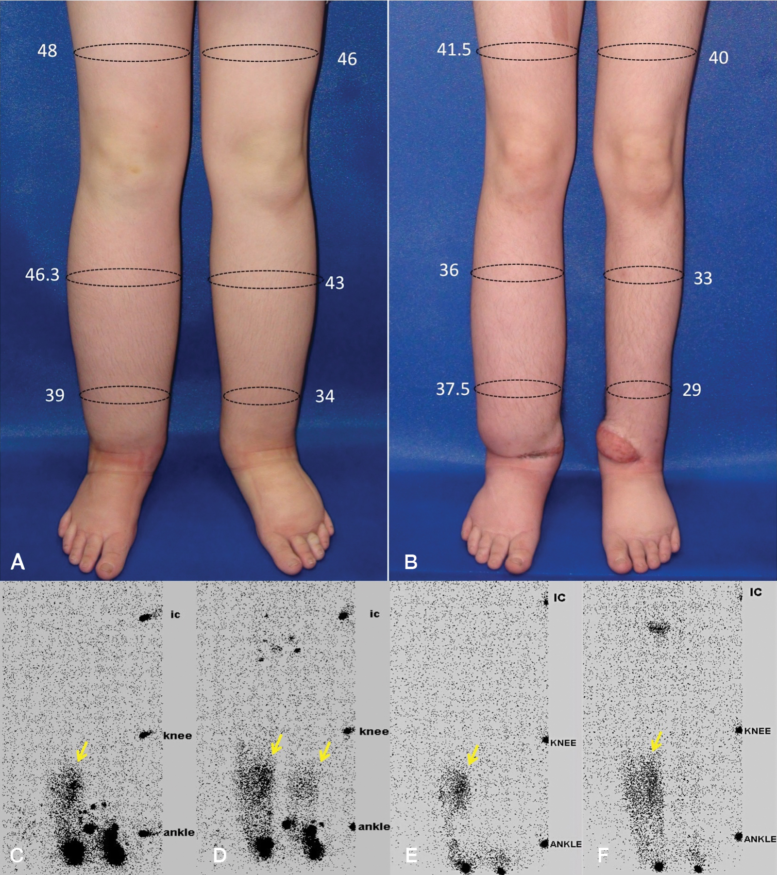 Primary Lymphedema With Concomitant Vascular And Lymphatic Lesions ...