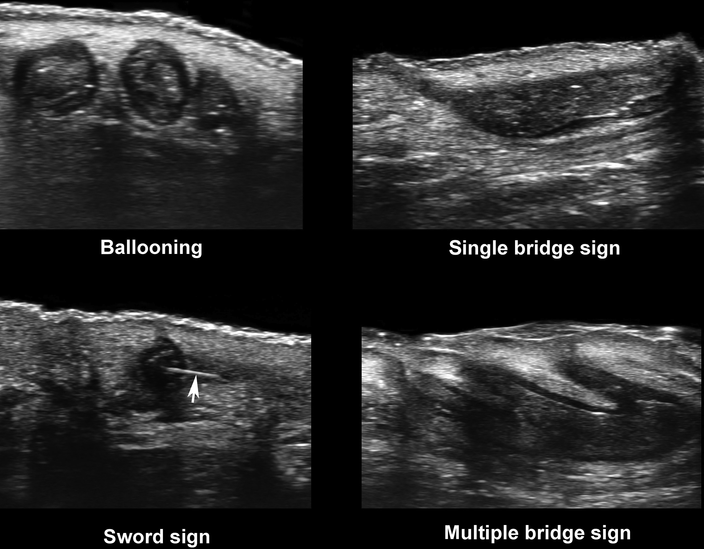 Imaging Techniques In Hidradenitis Suppurativa And Comorbidities ...