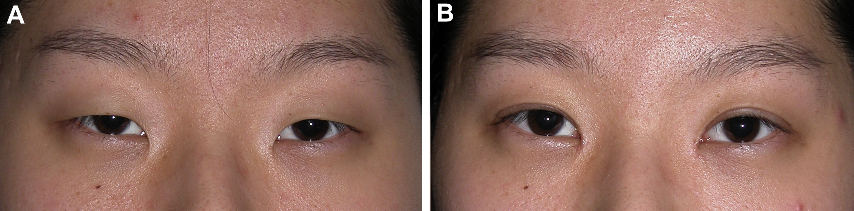 Nonincisional Blepharoplasty For Asians | Plastic Surgery Key