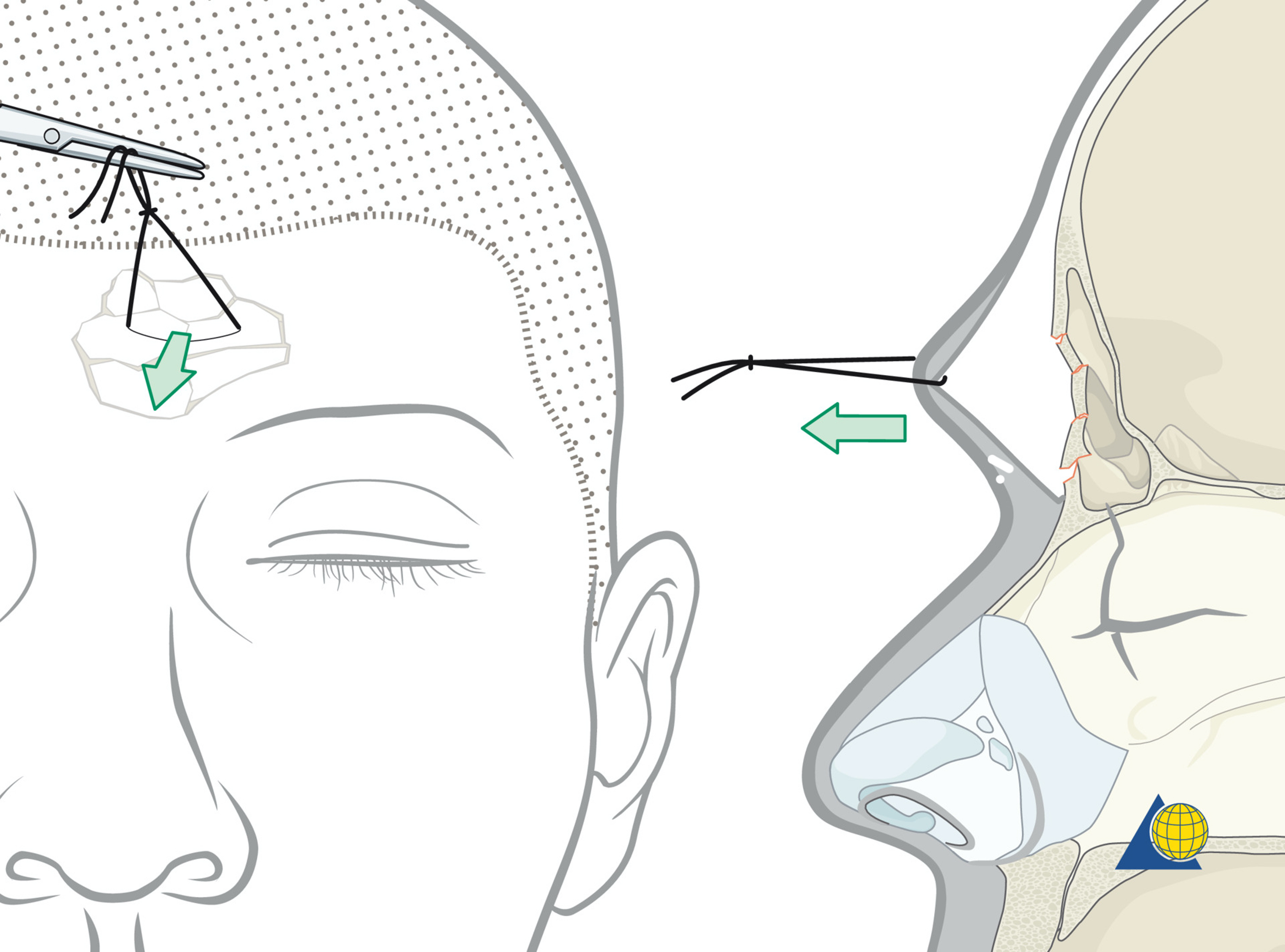 Frontal Sinus Fractures | Plastic Surgery Key