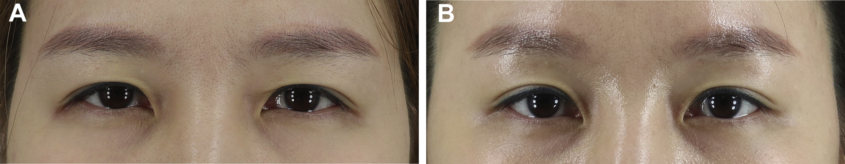 Incisional Blepharoplasty For The Asian Eye | Plastic Surgery Key