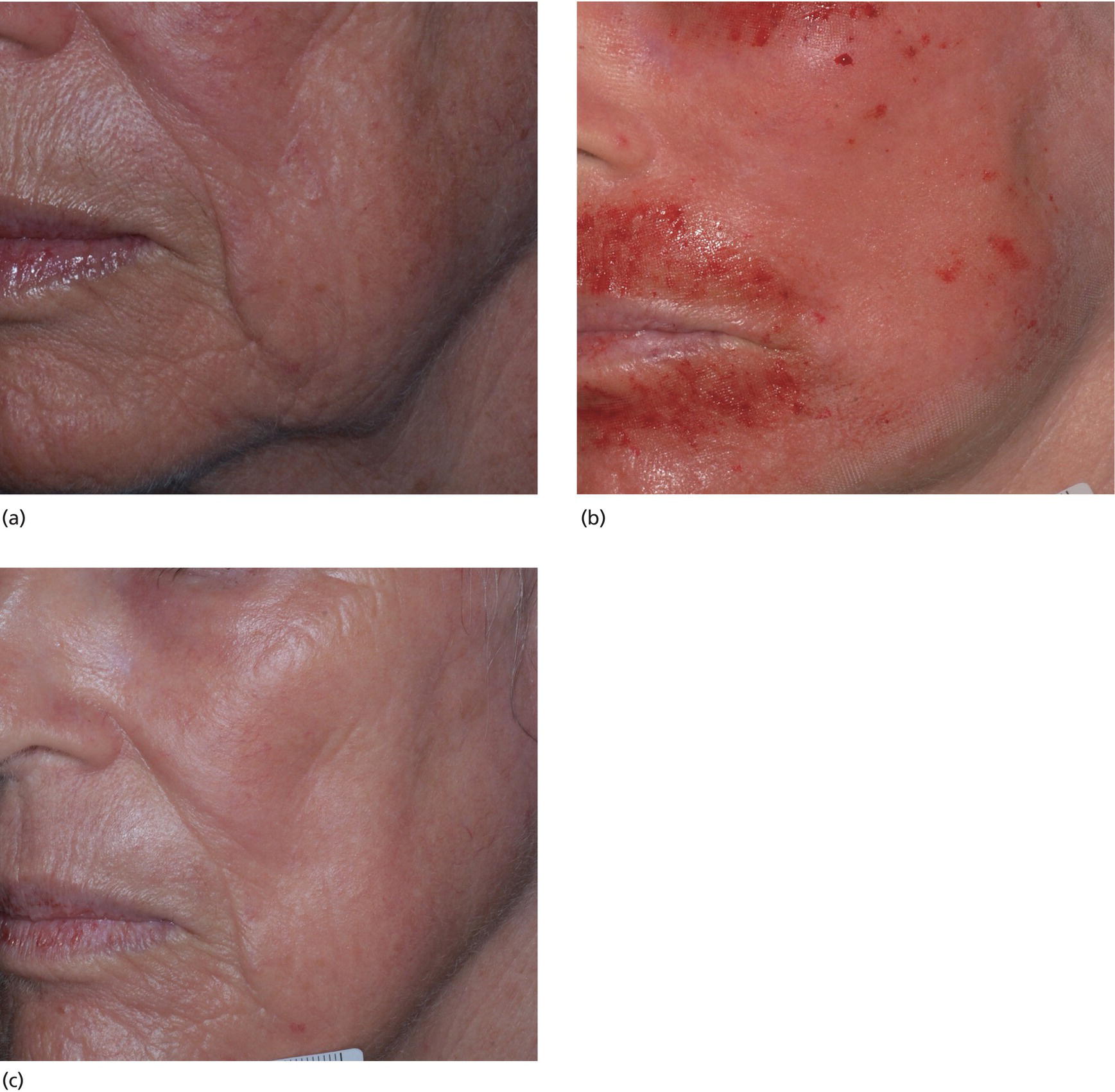 51: Ablative Laser Resurfacing: Confluent And Fractionated | Plastic ...