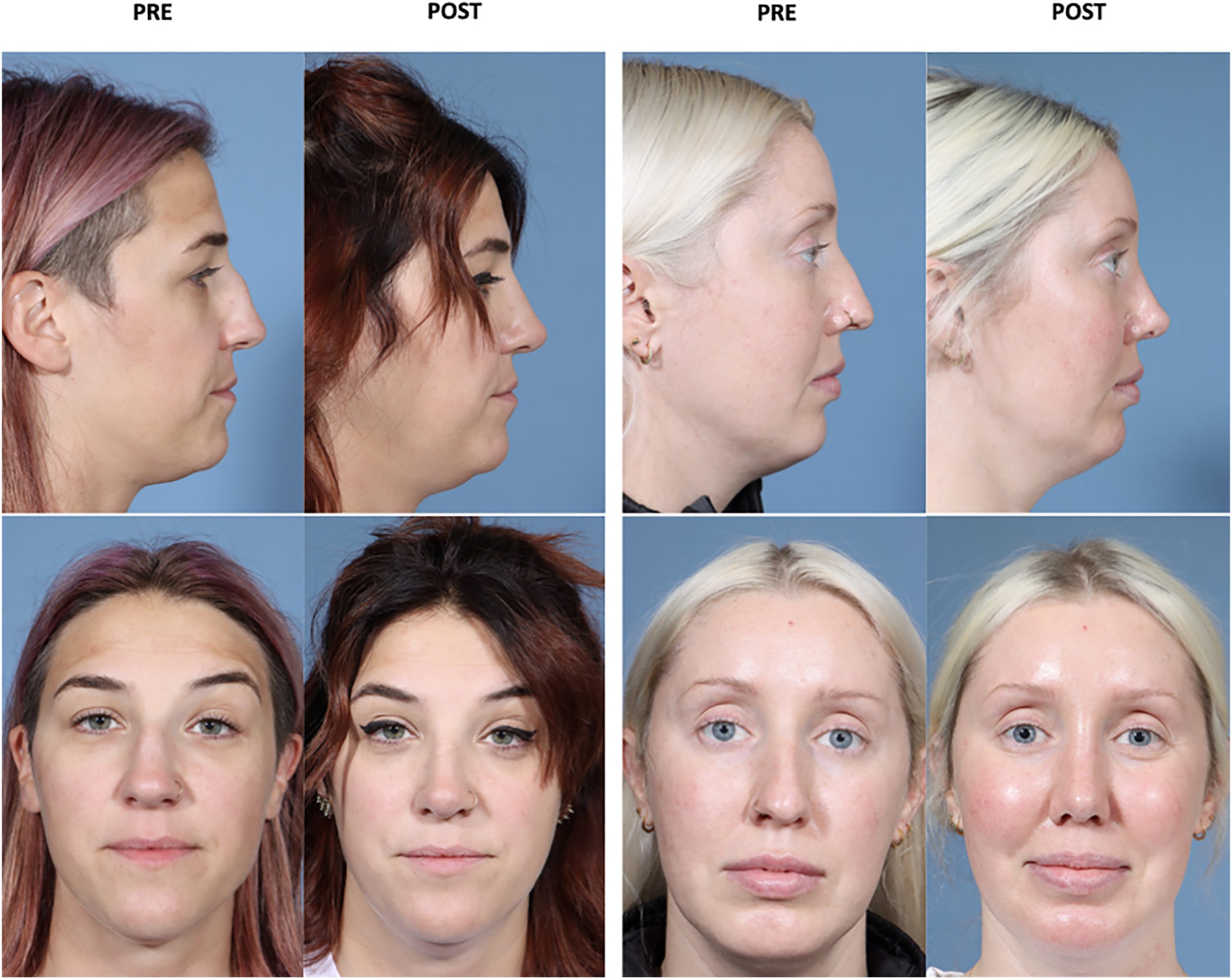 健康・医学 Preservation Rhinoplasty Preservation Rhinoplasty—Outcomes in Dorsal Preservation