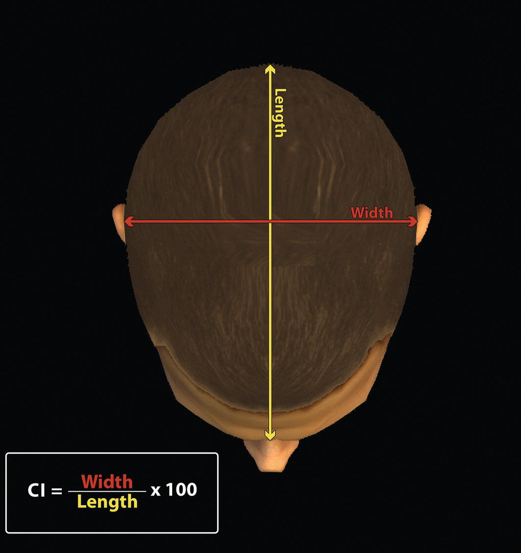 An illustration showing a top view of a head with labeled measurements for width (red) and length (yellow). The formula for cranial index (CI) is displayed below: CI = (Width / Length) x 100.