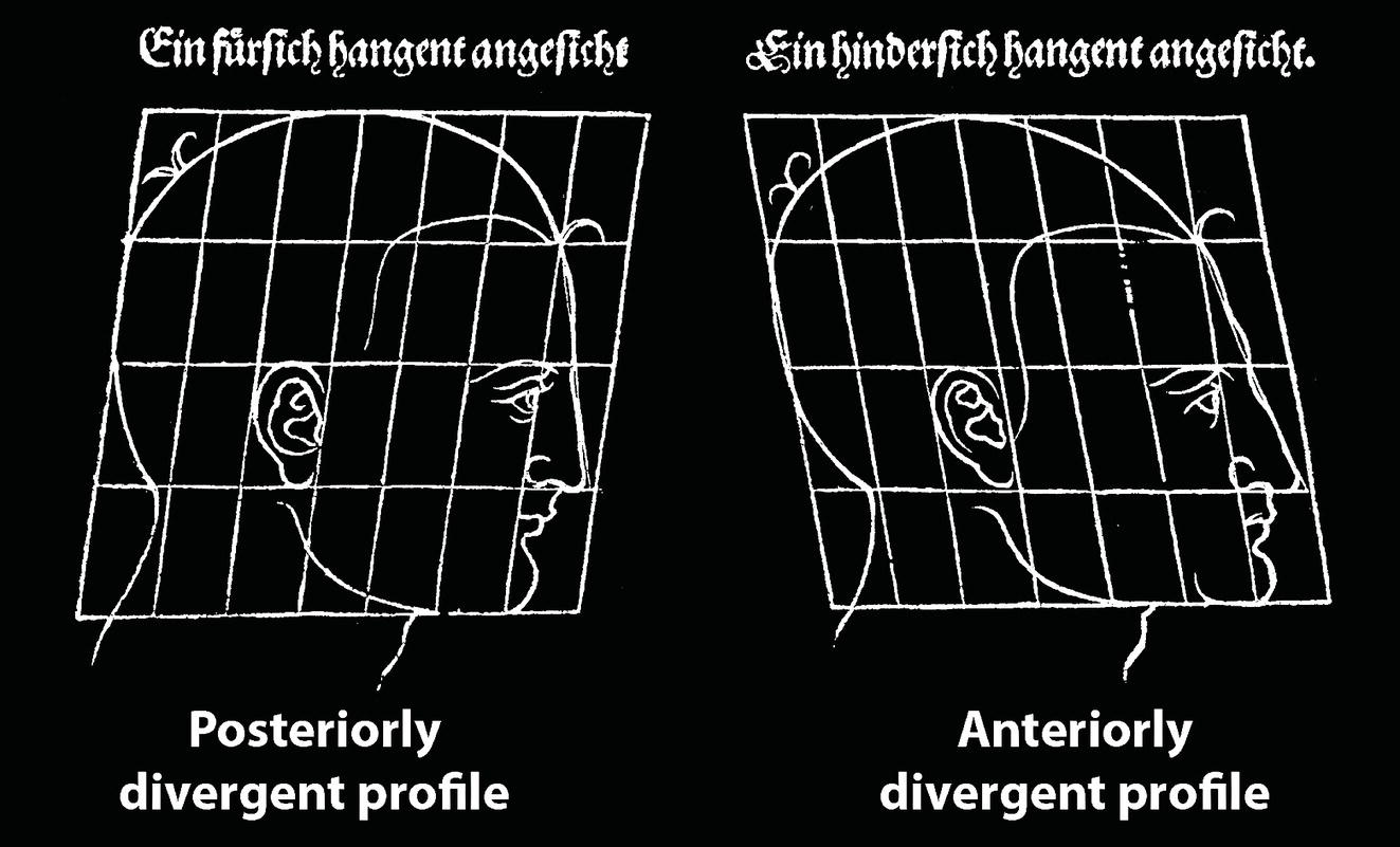Two diagrams of head shapes: the left shows a posteriorly divergent profile, while the right displays an anteriorly divergent profile. Both diagrams are overlaid with a grid for measurement reference.