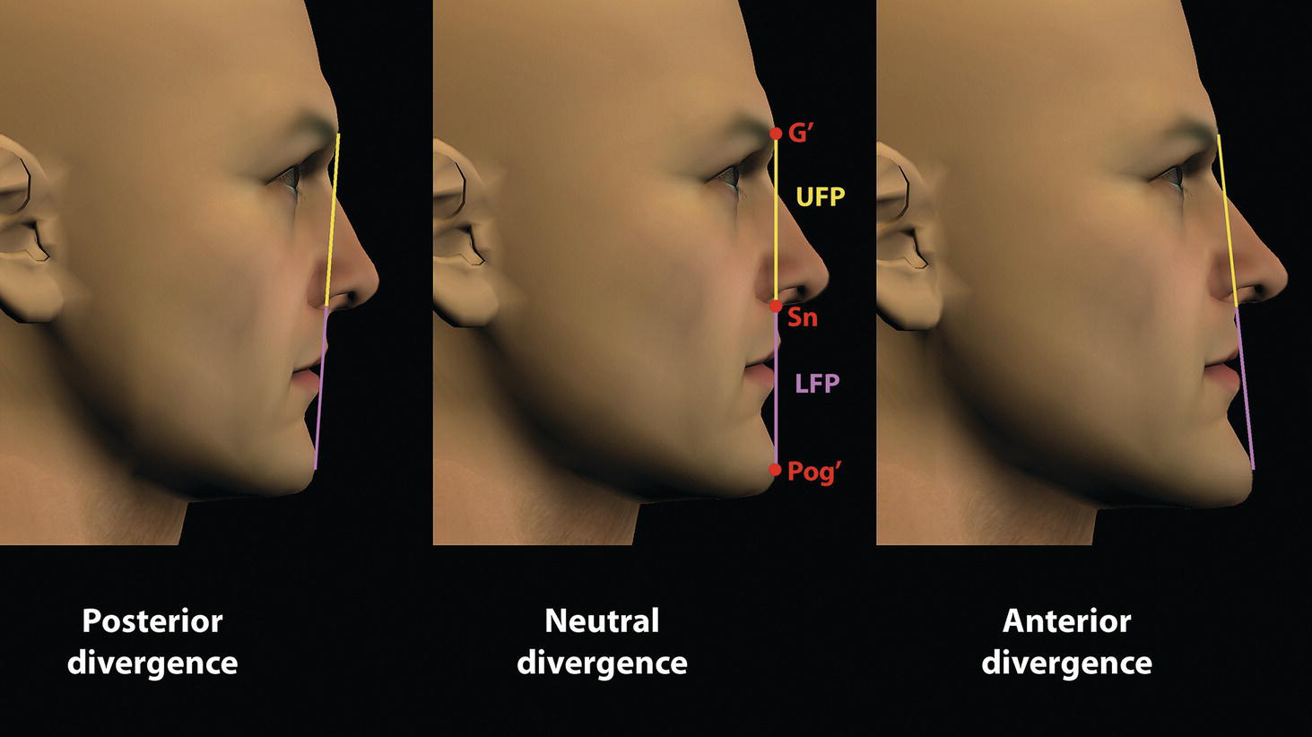 Three profile views of head shapes: Posterior divergence on the left, Neutral divergence in the center, and Anterior divergence on the right. Each view is labeled with key measurement points.