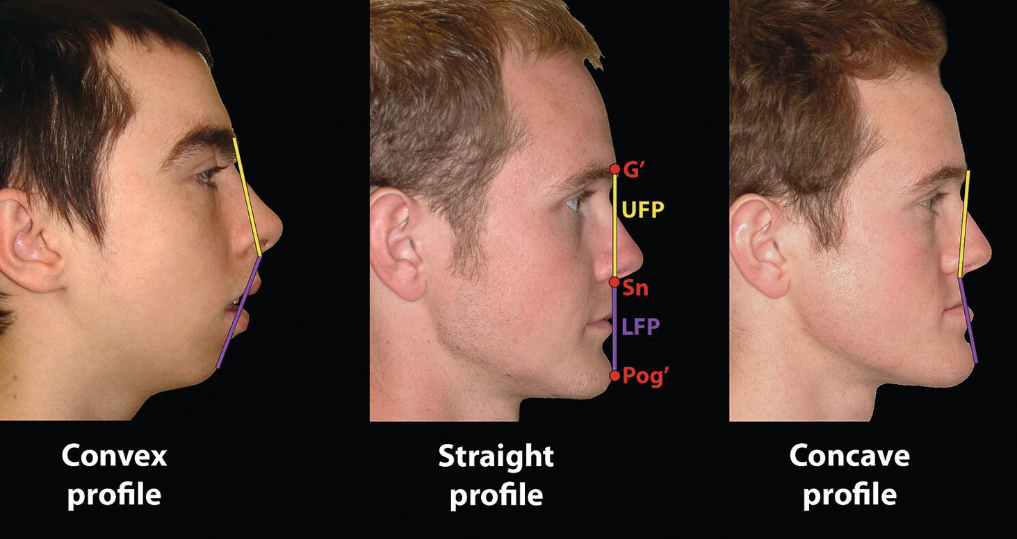 Three side profile views of facial shapes: Convex profile on the left, Straight profile in the center, and Concave profile on the right. Each profile includes labeled anatomical landmarks like Sn and Pog'.