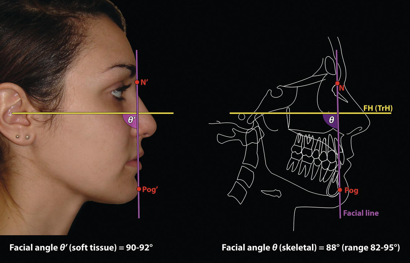 Two panels: Left panel shows the side profile of a woman with the soft tissue facial angle (90 to 92 degrees) labeled at points N' and Pog'. Right panel displays an X-ray illustration depicting the skeletal facial angle (88 degrees, range 82 to 95 degrees) with labeled anatomical markers.