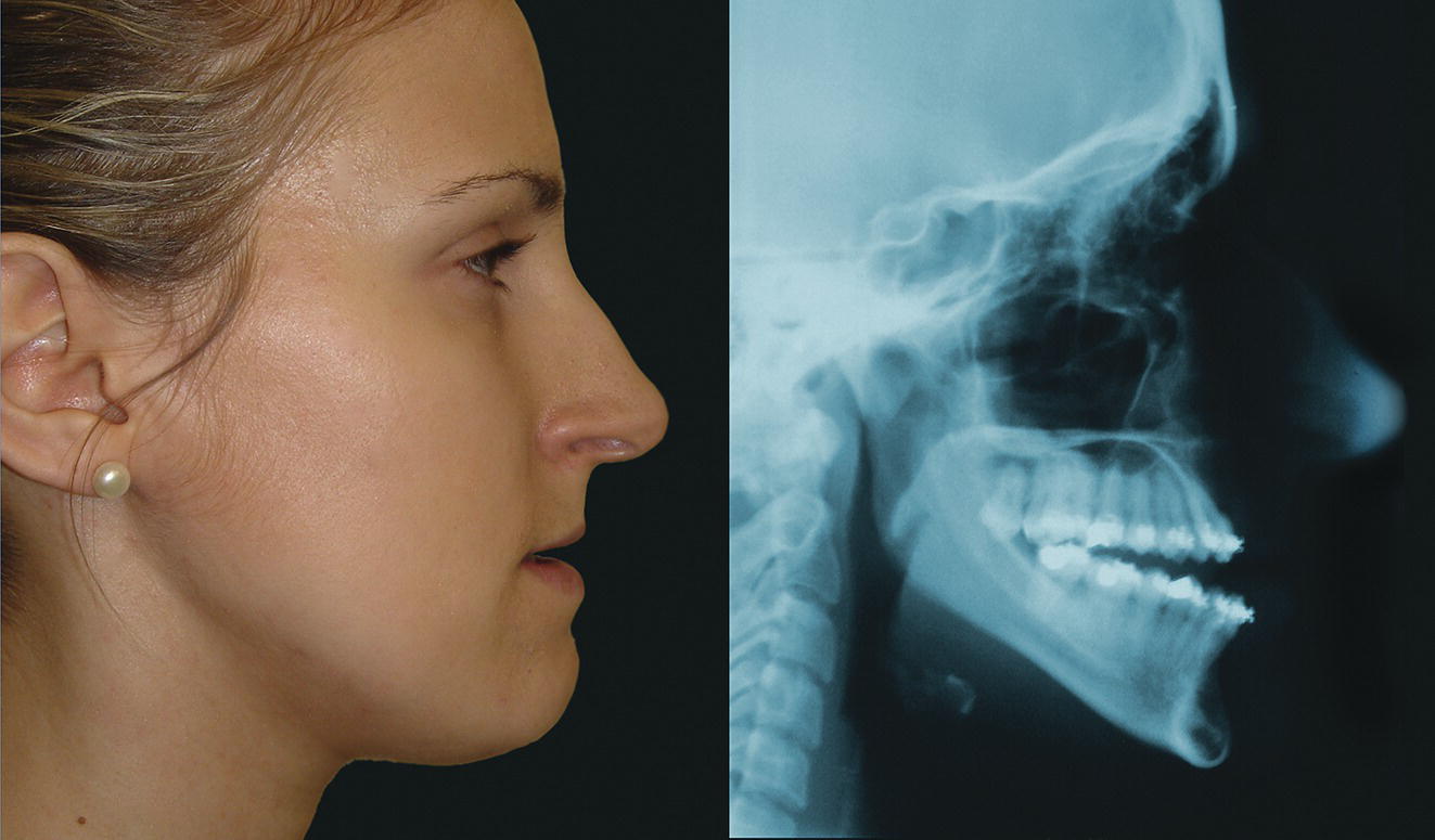 A side profile of a woman contrasted with an X-ray view of her skull. The image highlights the relationship between external facial structure and internal jaw alignment.