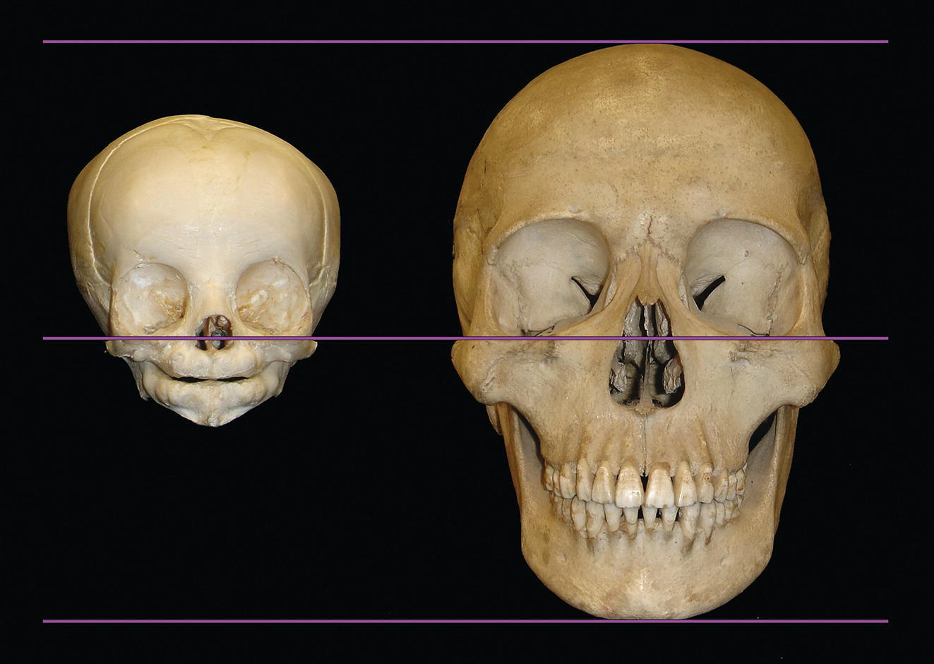 Two skull images side by side on a dark background, labeled with purple lines. The image on the left shows an infant skull, while the right displays an adult skull, both clearly illustrating structural differences.