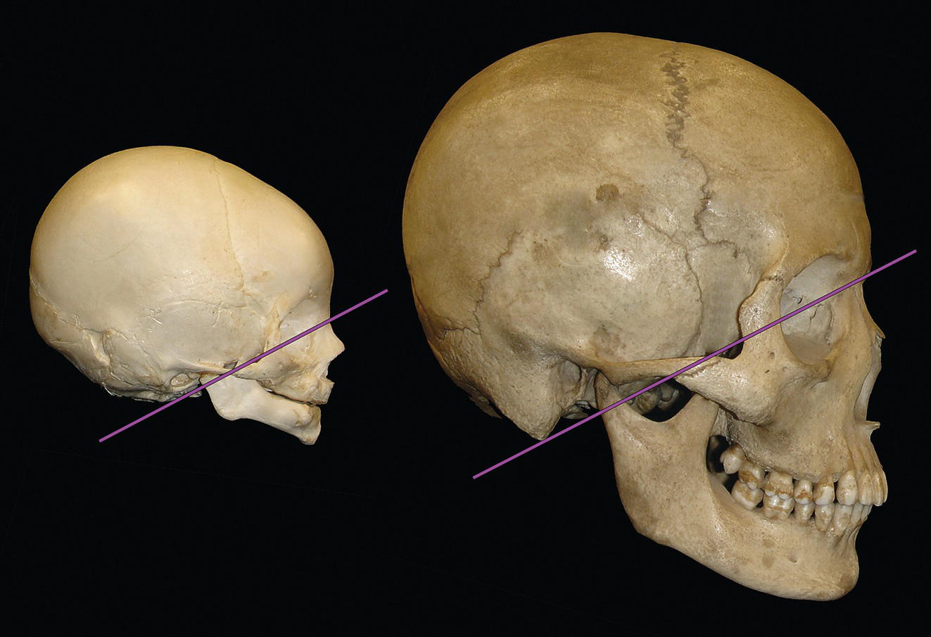 A side-by-side images of an infant skull and an adult skull, both displayed against a black background. Purple lines indicate key reference points, highlighting the differences in size and structure.