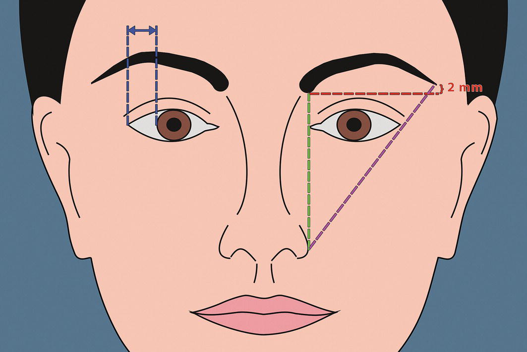 An illustration of a face with geometric measurements around the eyes, labeled with dimensions. Dashed lines indicate specific angles and distances for anatomical reference.